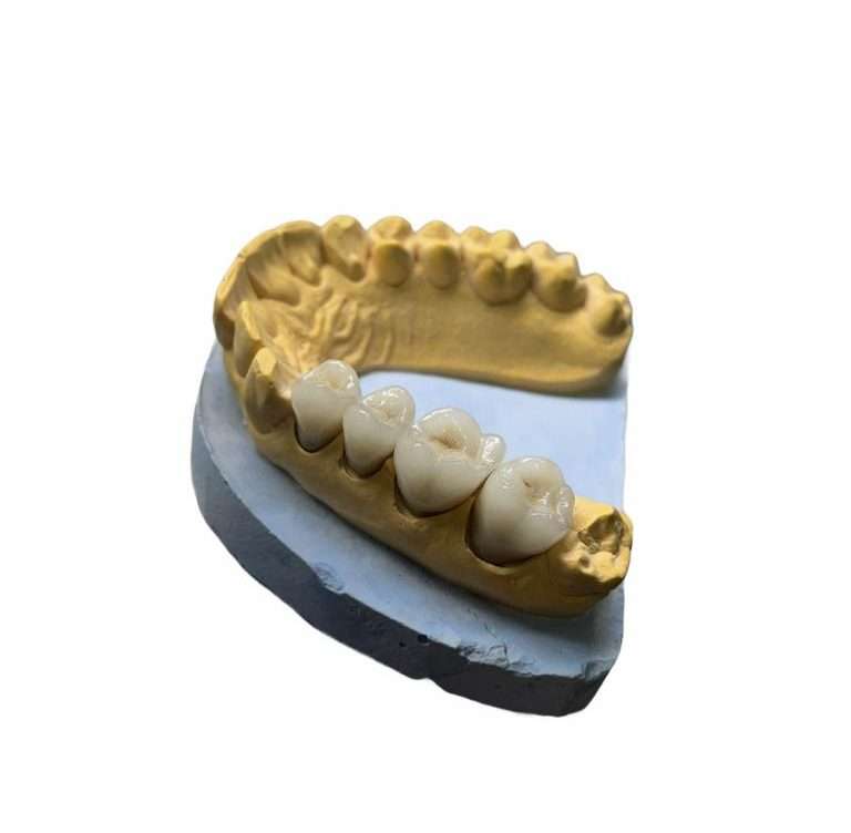 Modelo dental con coronas de porcelana para rehabilitación oral en clínica dental en Jerez