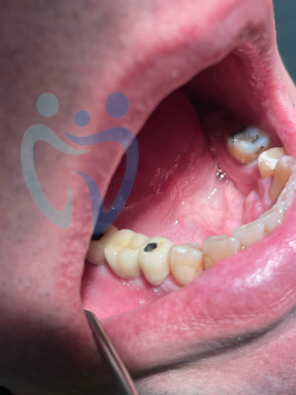 Implantes dentales Jerez